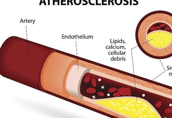 动脉硬化不是老年人的专属糖尿病人更易得饮食预防是关键