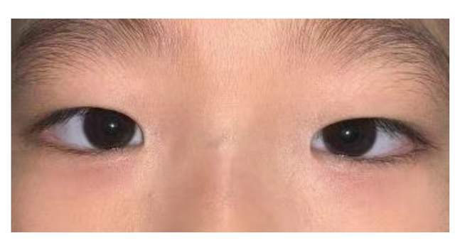 孩子倒睫千万别乱拔小毛病也可引起大问题