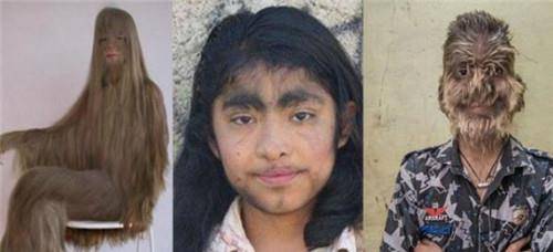 多毛症,根据科学家研究,此症状是因为基因突变,导致身体出现返祖现象