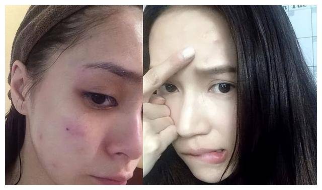 刷酸 光子嫩肤,但这个看个人体质,有些人就算用这些手段也没啥用,一些