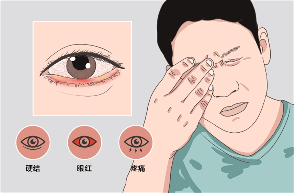 类风湿关节炎也可能累及眼部,引发多种眼部炎症,如巩膜炎,虹膜炎和