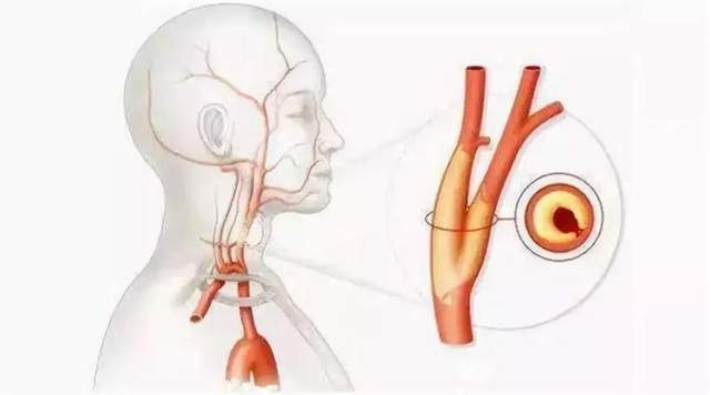 如何检测?_血管_胆固醇_物理检查