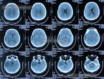 图-19:2023年10月9日头颅ct2023年10月18日(治疗5个月),出院时:入院时
