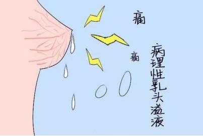 乳头溢液是癌症吗?能治好吗?