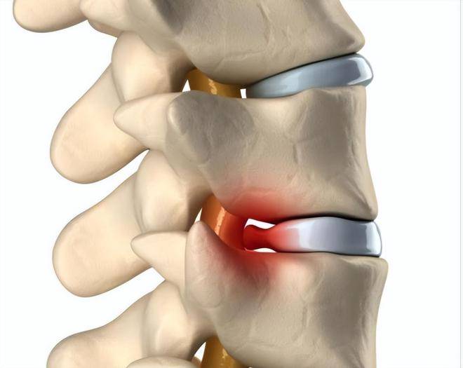 腰椎间盘突出到底怎么回事