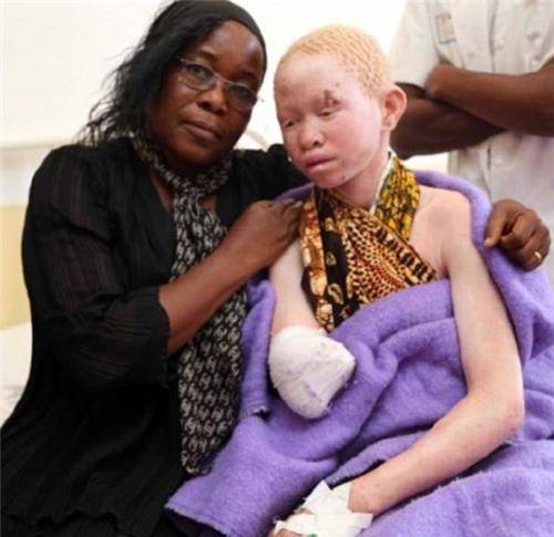 第二种谣言带来的后果则更加可怕,在坦桑尼亚,许多人相信白化病人的