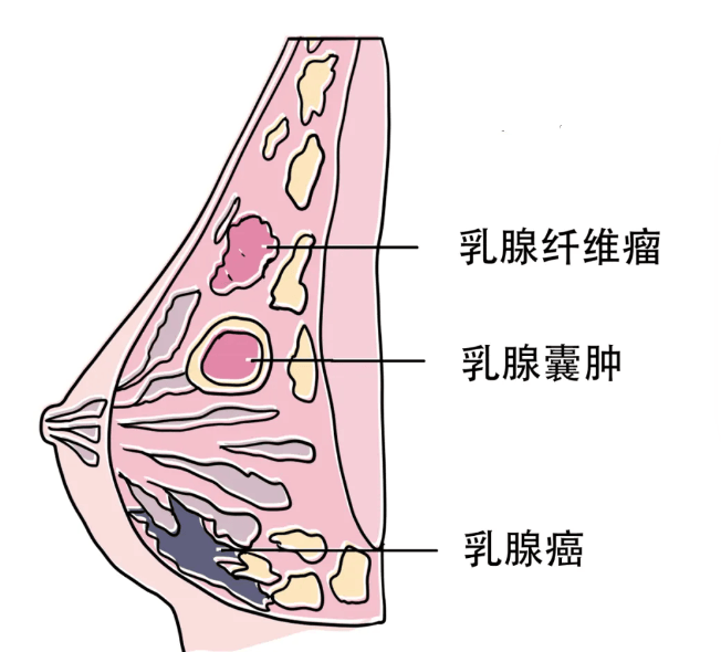 乳腺结节会变成乳腺癌吗?