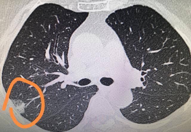 查出肺结节,不能吃"大虾"吗?_肺部_食物_钙化