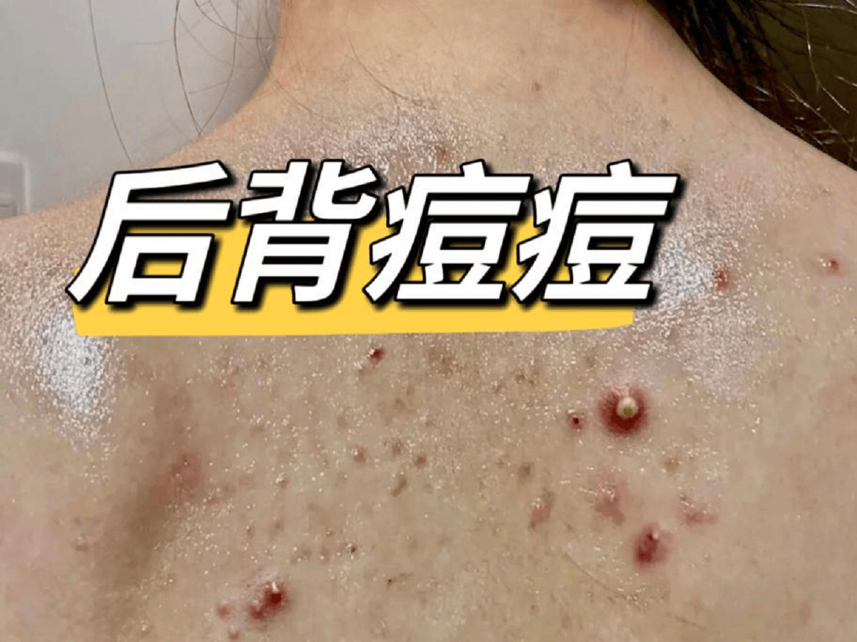 后背脓包痘终于消失了过来人经验千万别错过看完立省大几千