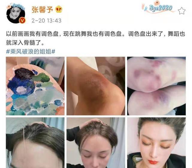 张馨予晒浪姐2练舞伤痕膝盖青紫一片像调色盘看着都疼
