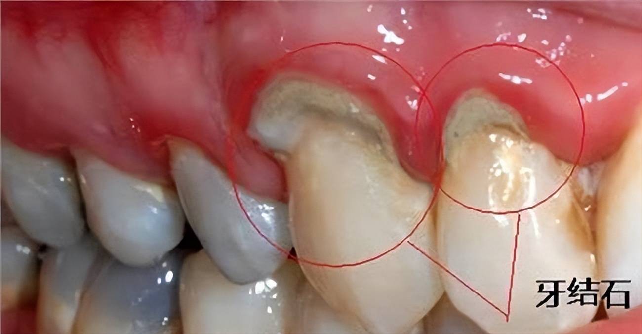 牛掰竟然只用了两个方法就将多年的牙结石根除了效果顶呱呱
