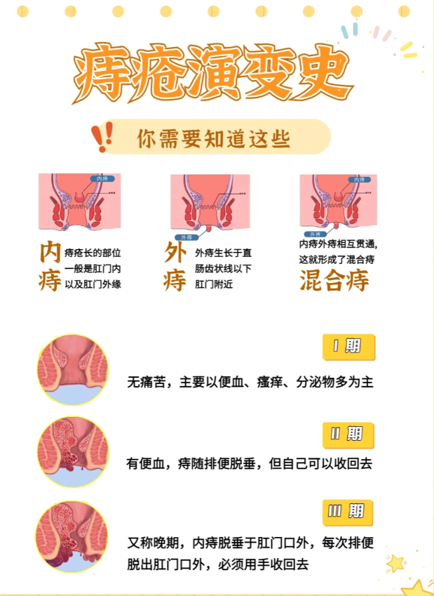 痔疮看什么科图片