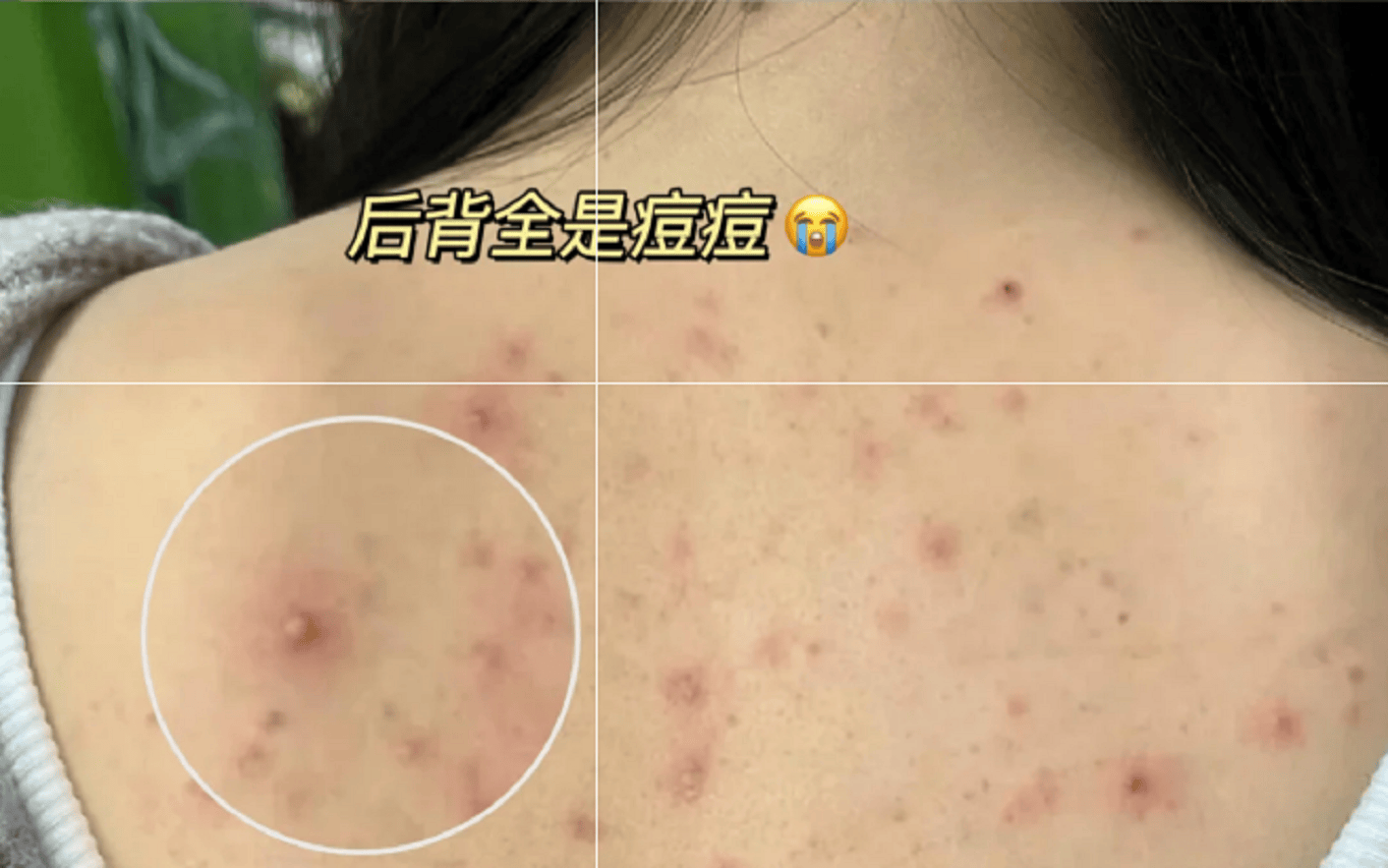 去后背痘竟然如此简单每天只需做好这两步顽固脓包痘洗洗就掉