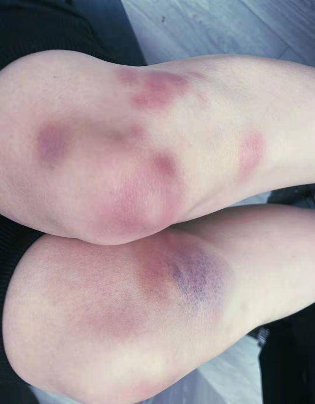 《浪姐2》中练习舞蹈真的是太拼了,两条腿的膝盖处青一片紫一片,可以