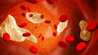 原创血栓的头号天敌终于被找到了每天喝两口血管干净不堵塞