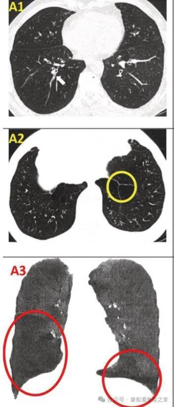 未来可期全球首个牙囊干细胞治疗牙周病临床研究开展干细胞真的有效吗