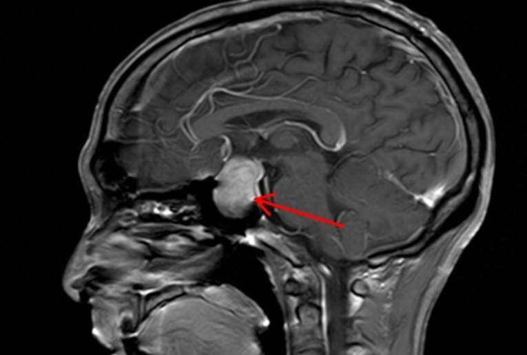 脑垂体瘤长相图片