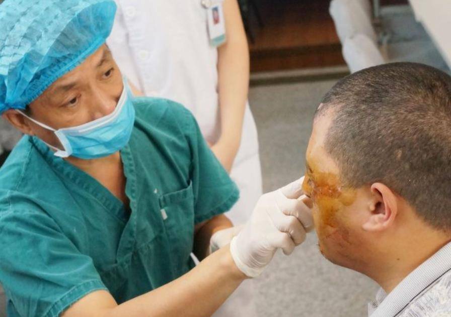 原创湖北小伙被烧伤严重毁容7次整形手术后记录下人生第一张自拍