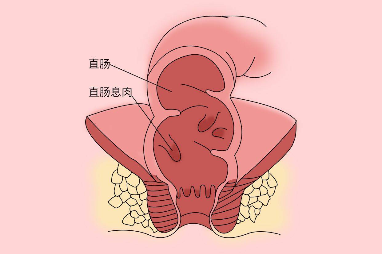 肛裂赘生物图片图片