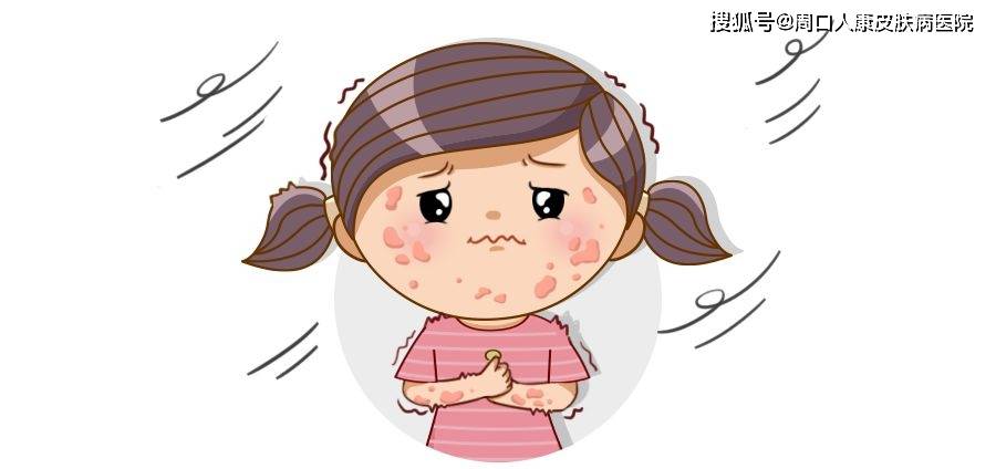 【周口人康皮肤病医院】如何识别和处理儿童荨麻疹?