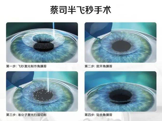 南昌的近视朋友,什么人适合做半飞秒近视手术?_角膜_眼睛_人群