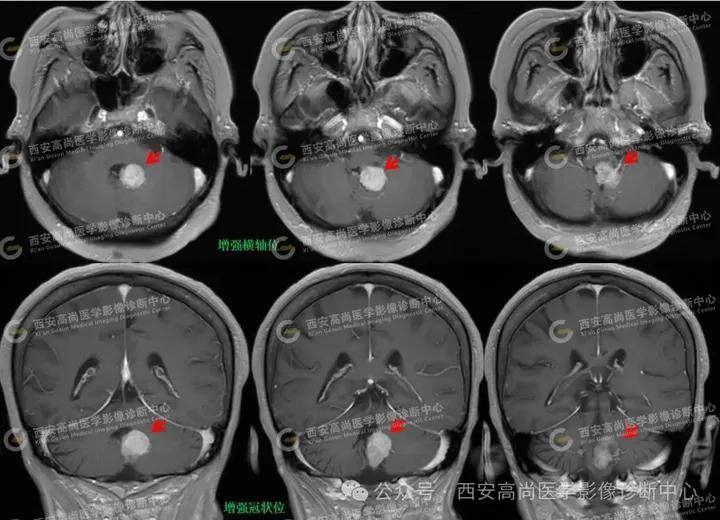 疾病科普:第四脑室室管膜瘤
