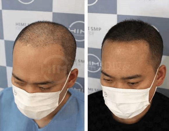 黑米3d纹发15浓度的米诺地尔你用过吗