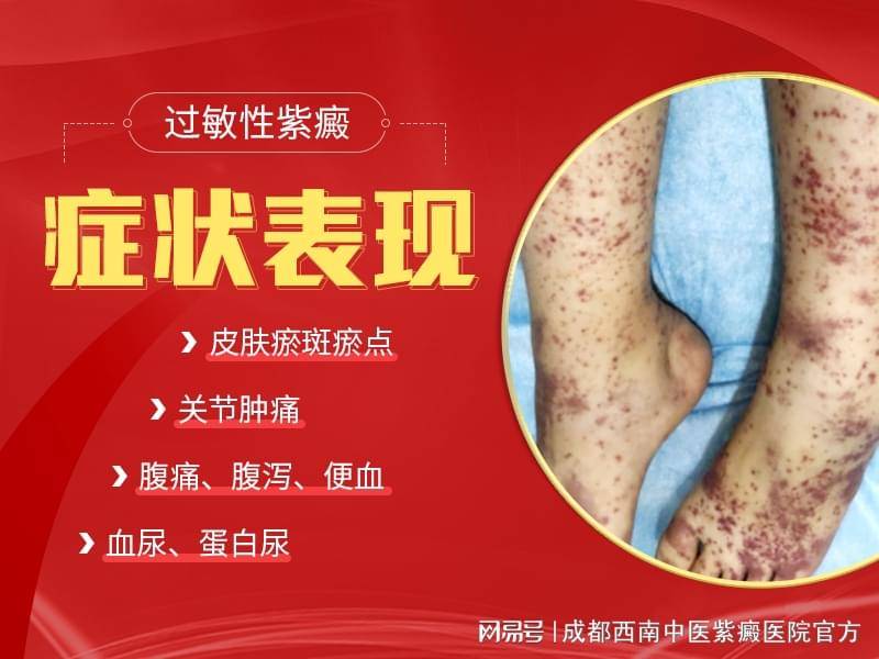 甘肃过敏性紫癜如何判断成都西南中医医院
