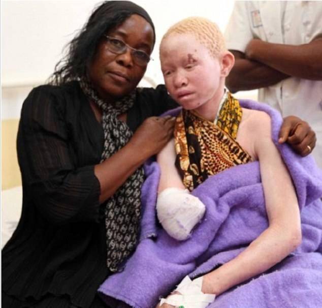 原创非洲白化病人被当做巫医祭品遭猎杀身体器官被抢走做成药