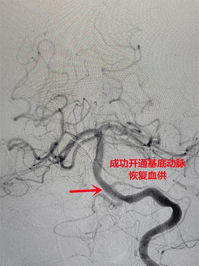 术前对于基底动脉这类大动脉闭塞的患者而言,动脉取栓更有效,与患者