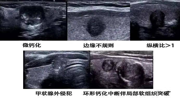 甲状腺结节恶变信号图片