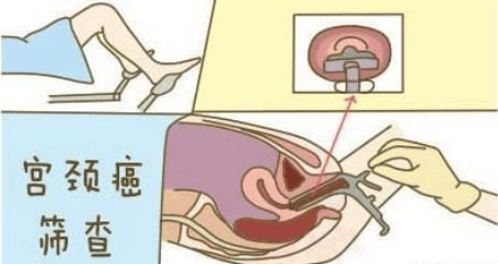 宫颈癌筛查到底选 hpv还是 tct?上海衡山虹妇幼医院