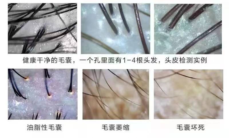 通过移植自身健康的毛囊到脱发区域,达到重建发际线和增加头发密度的