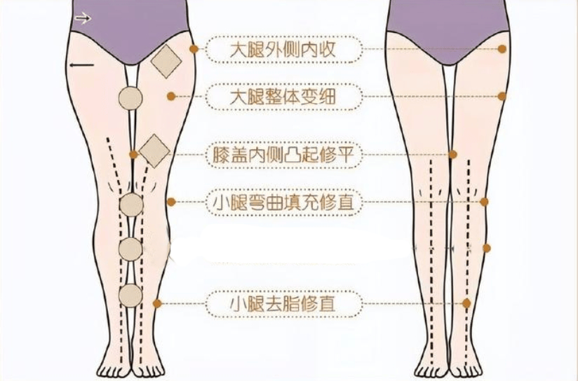 直腿术的细节部位处理对于大腿外侧的脂肪堆积