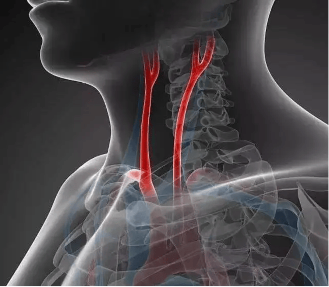 颈动脉小球图片