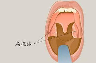 孩子扁桃体反复发炎?防范妙招有这几点