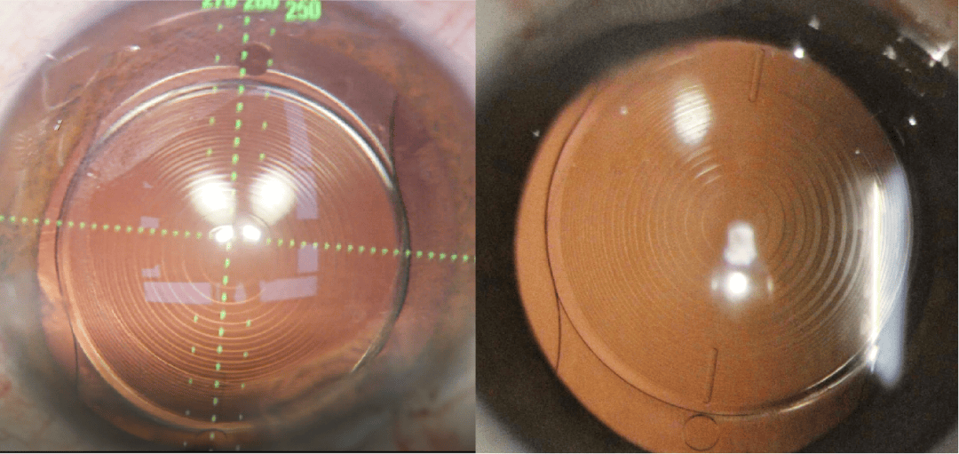 沈阳爱尔卓越眼科医院张劲松院长完成全国首批散光矫正三焦点人工晶体