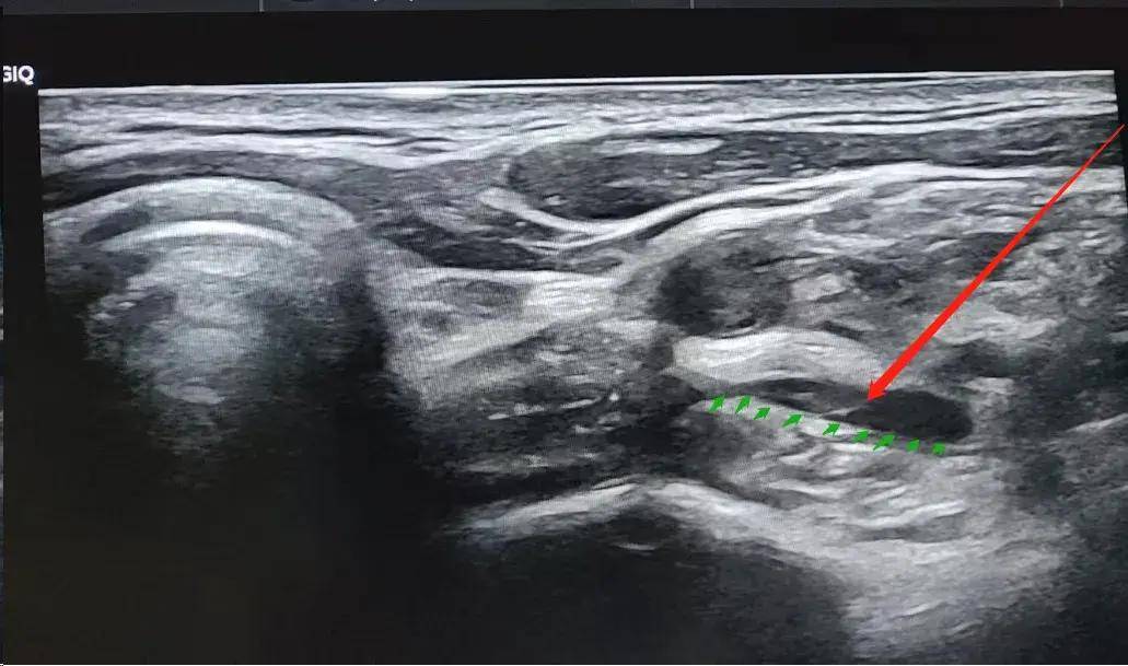 星状神经节阻滞超声图图片