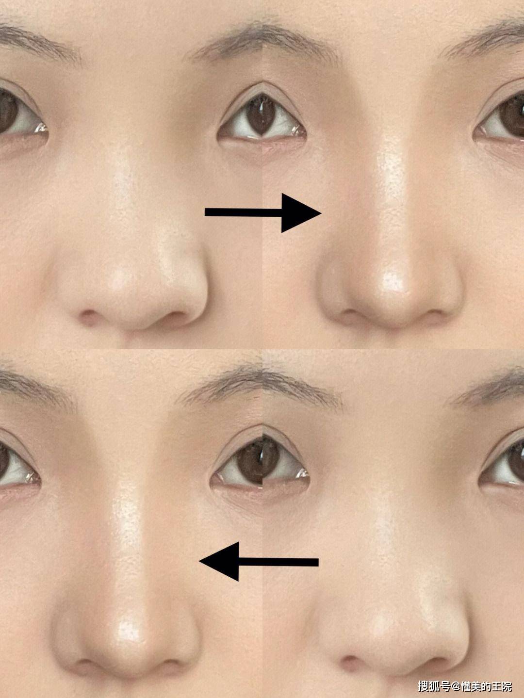 短鼻手术方案选择指南打造完美鼻型