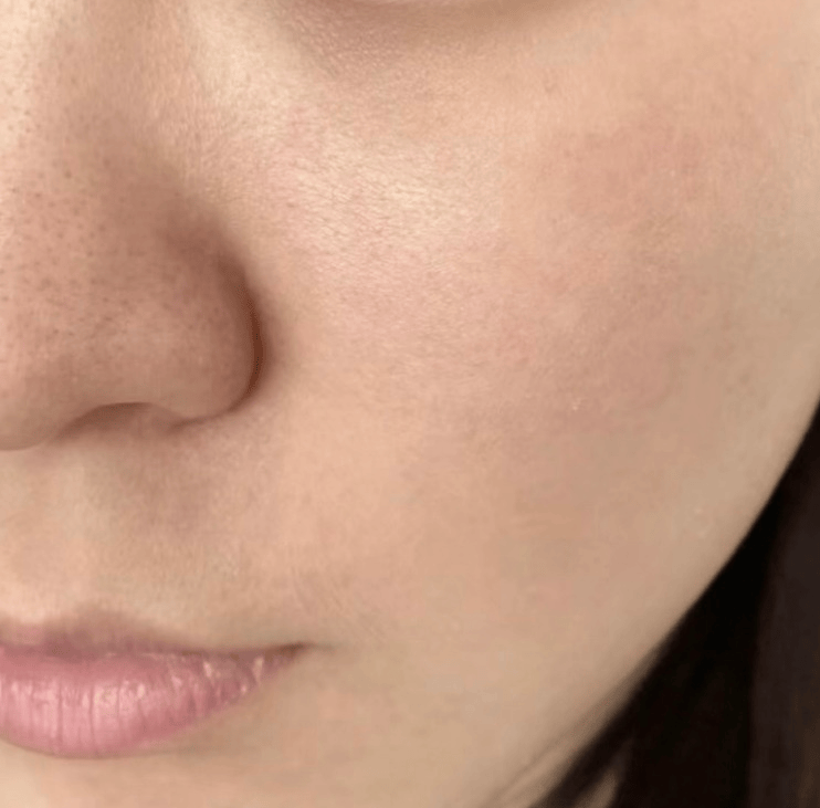 痘痘肌快看!3个快速祛痘不留印方法!过来人战痘经验总结!