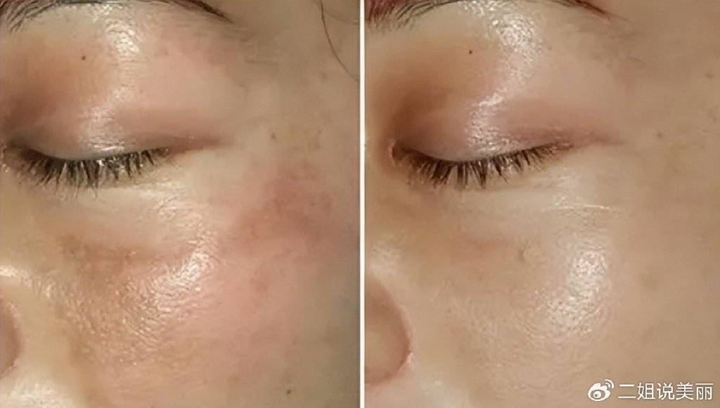 超皮秒恢复期多久超皮秒反黑后多久才能恢复正常服了