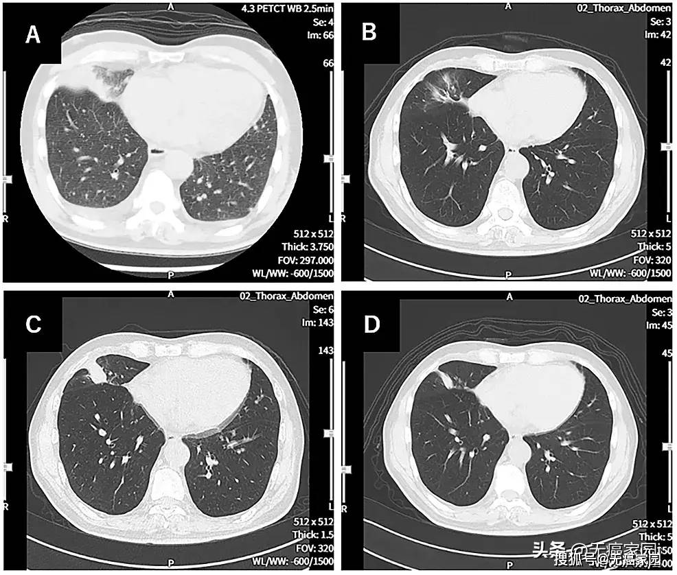 辅助细胞疗法联合全身治疗宣战实体瘤!_肿瘤_研究