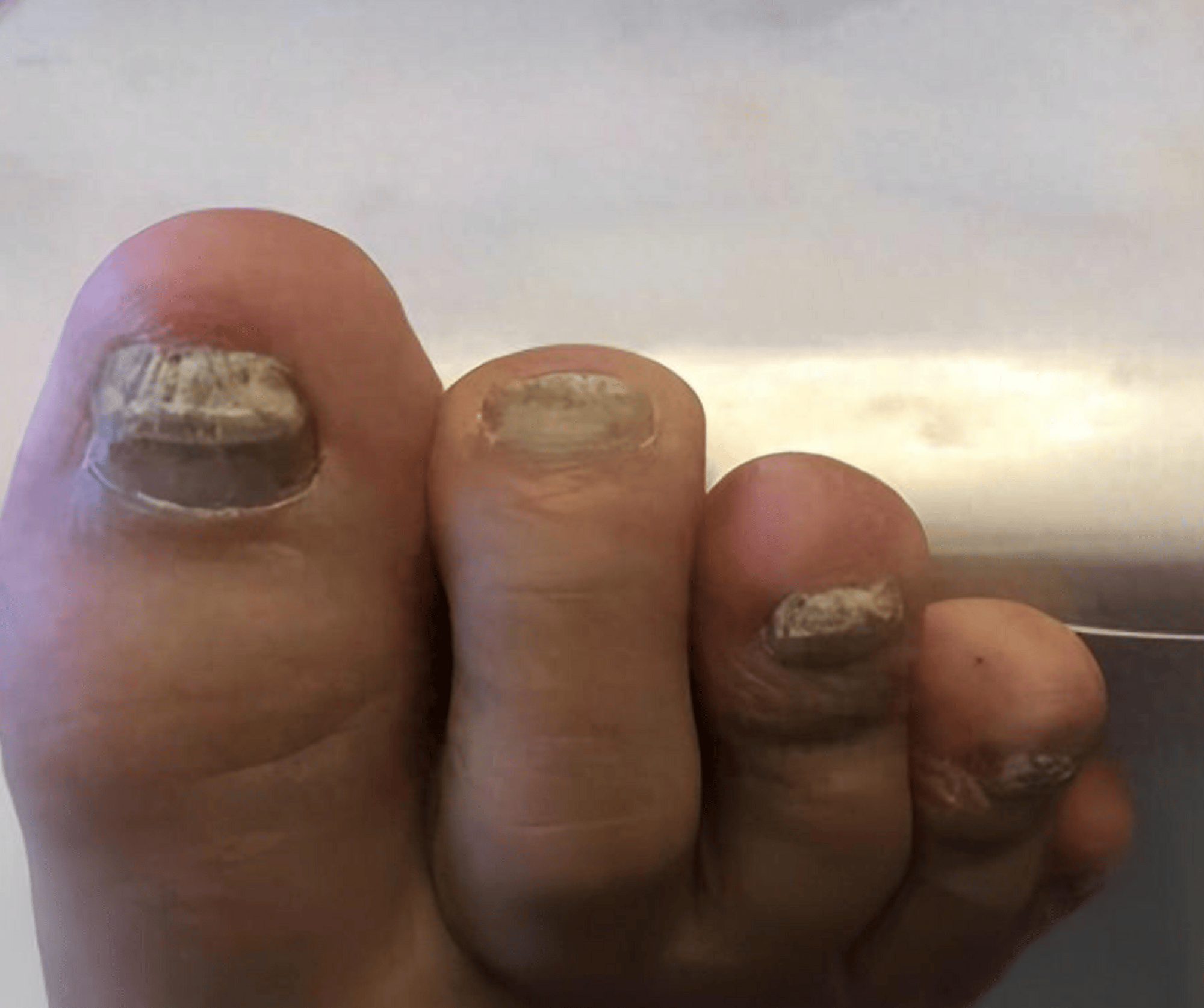 感染真菌得了灰指甲?3个方法教你除菌,泛黄增厚坏甲秒