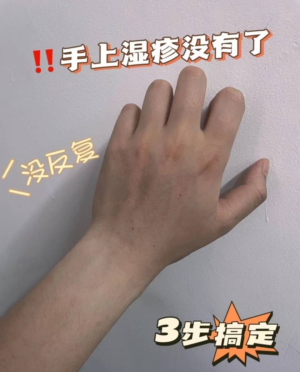 我服了3步搞定手上湿疹真的好用呀