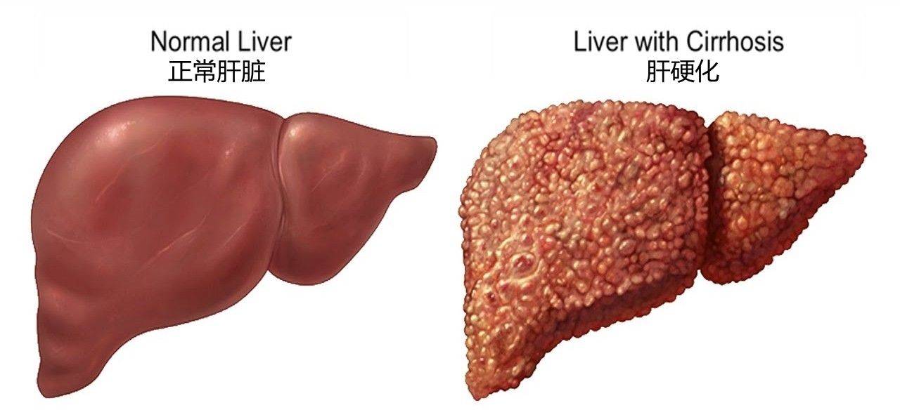 肝硬化患者一定要知道的几个问题