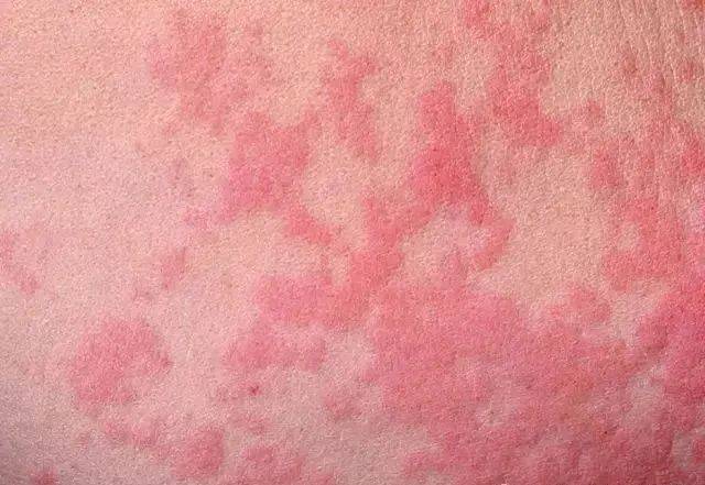 主要表现为突然发生的皮肤瘙痒,水肿性红斑,红色或白色风团.