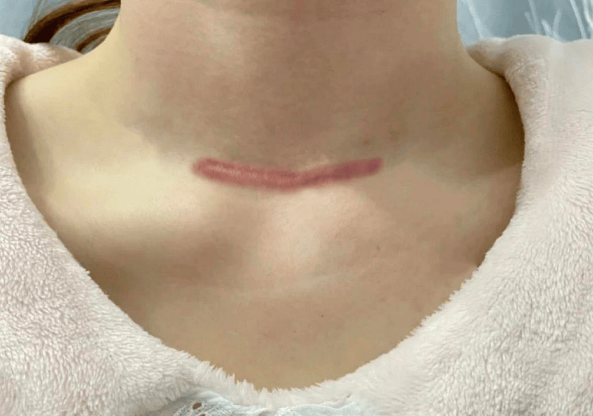 术后疤痕怎样才能有效去除?跟我学会这几招!疤痕踪迹彻底消失!