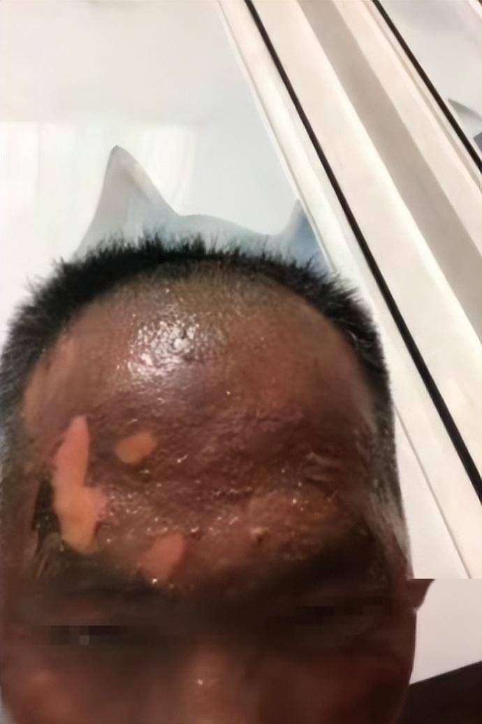 妻子烧开水烫烂老公的脸,后续反转再反转,伏弟魔遇上了家暴男?