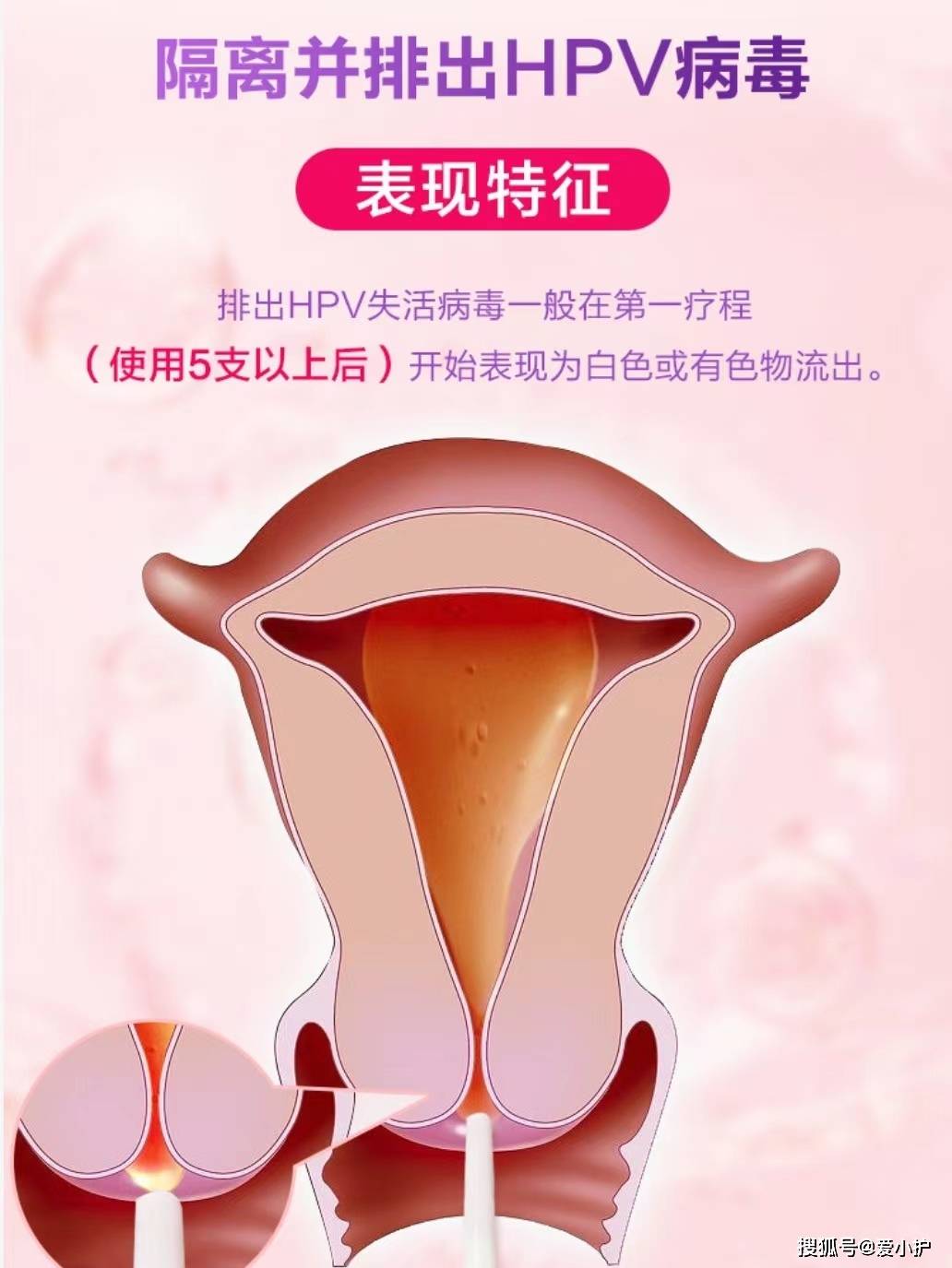 当"宫颈炎"遇上了"hpv",应该先治哪个?