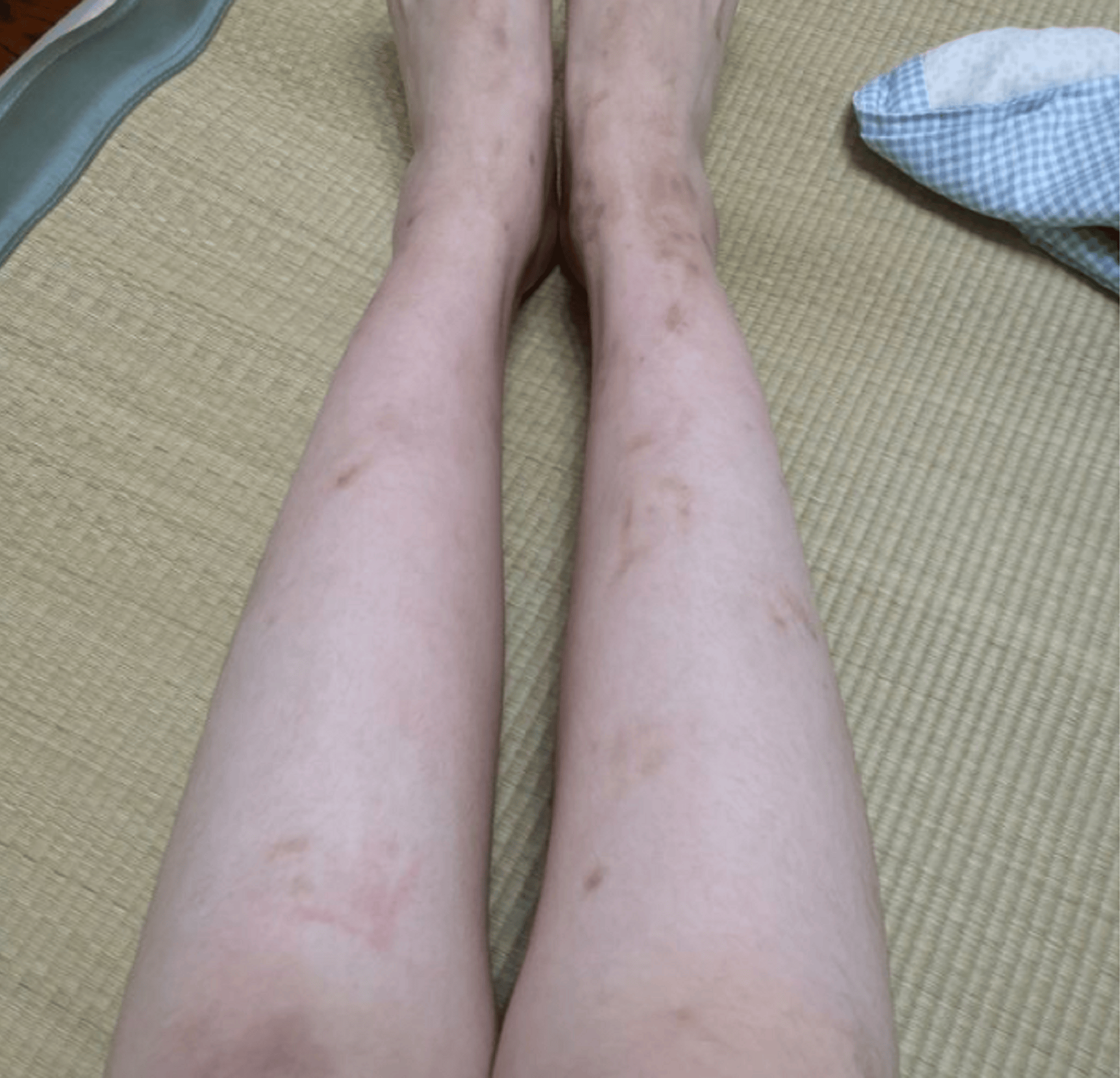 码住好用祛疤方法!疤痕体质朋友千万别错过!